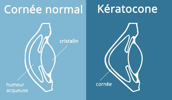 Lentilles pour kératocône